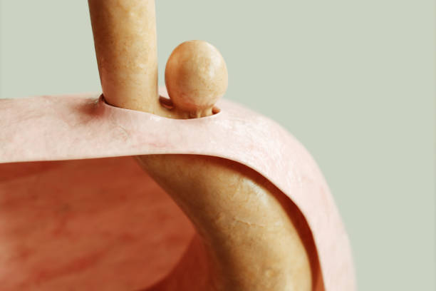 best surgeon for hiatal hernia laparoscopic repair in south mumbai